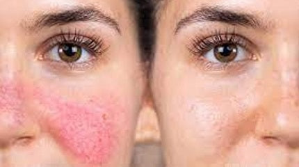 Rosacea